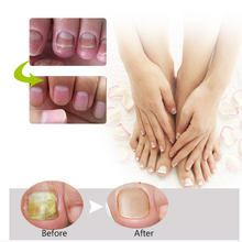 Load image into Gallery viewer, Nail Repair Treatment Gel